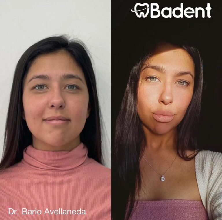 bichectomia antes y despues buenos aires