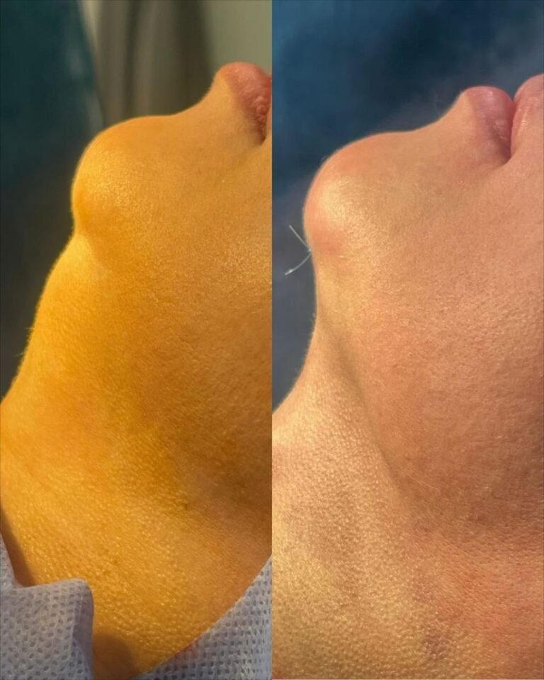 lipopapada antes y despues badent bairo avellaneda en buenos aires argentina