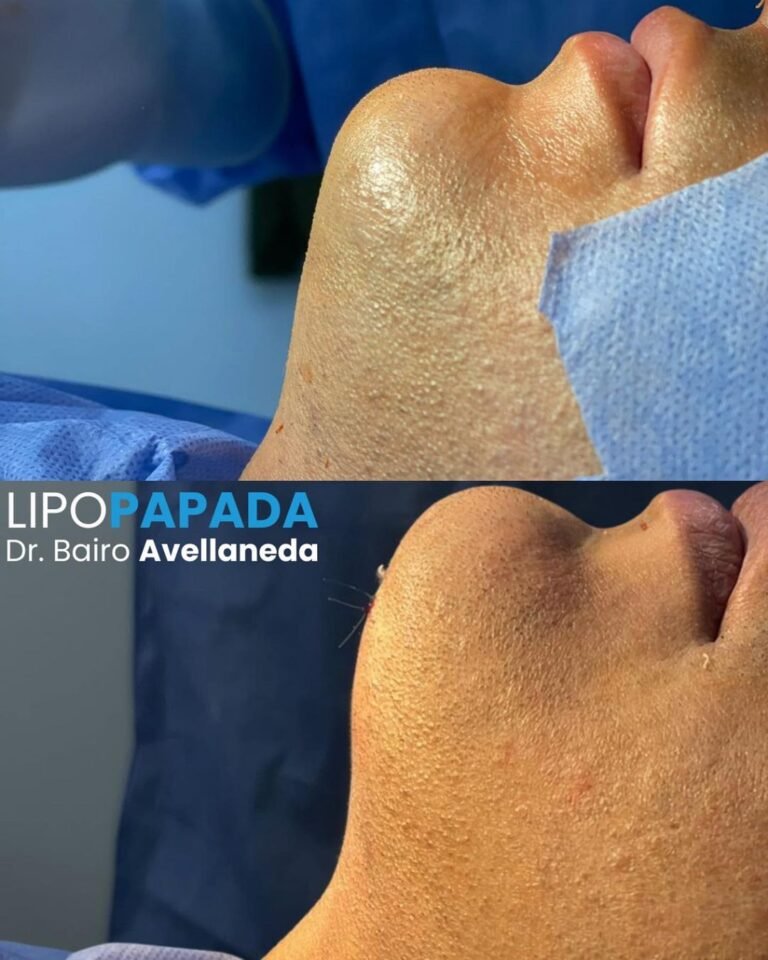 lipopapada antes y despues badent bairo avellaneda en buenos aires argentina