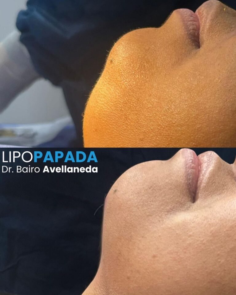 lipopapada antes y despues badent bairo avellaneda en buenos aires argentina