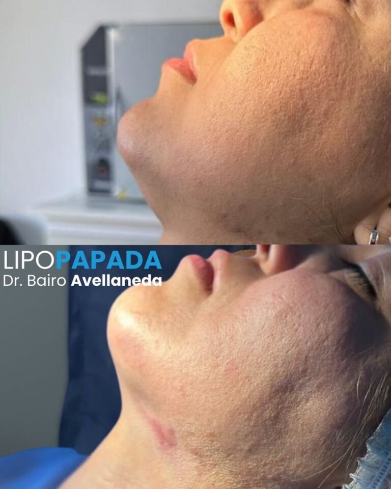 lipopapada antes y despues badent bairo avellaneda en buenos aires argentina