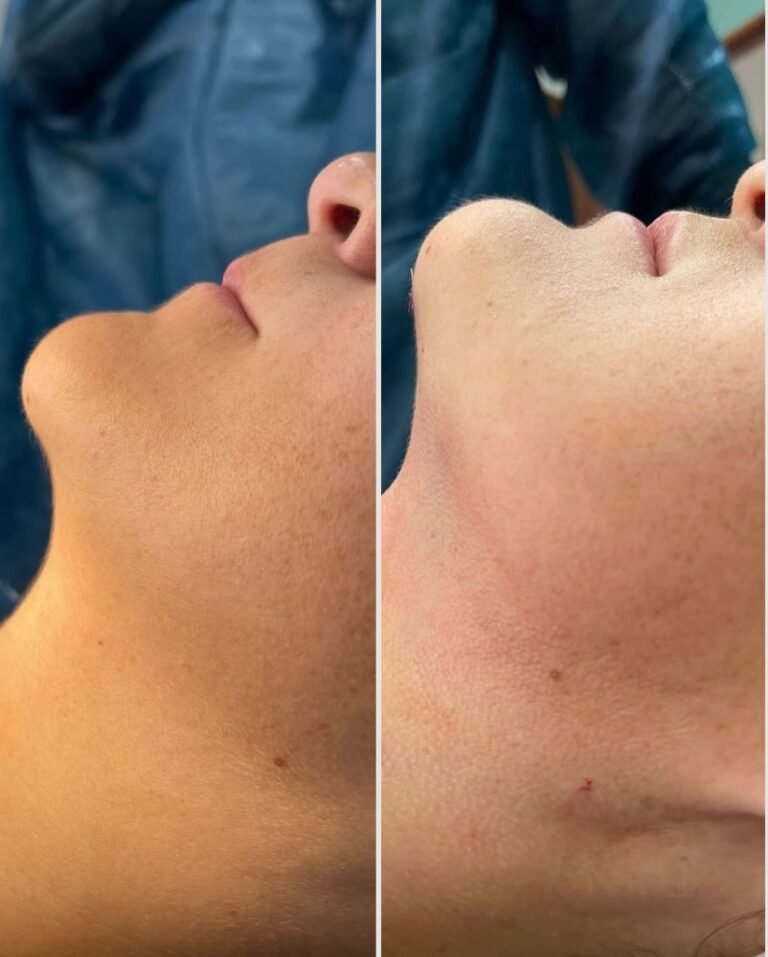 lipopapada antes y despues badent bairo avellaneda en buenos aires argentina